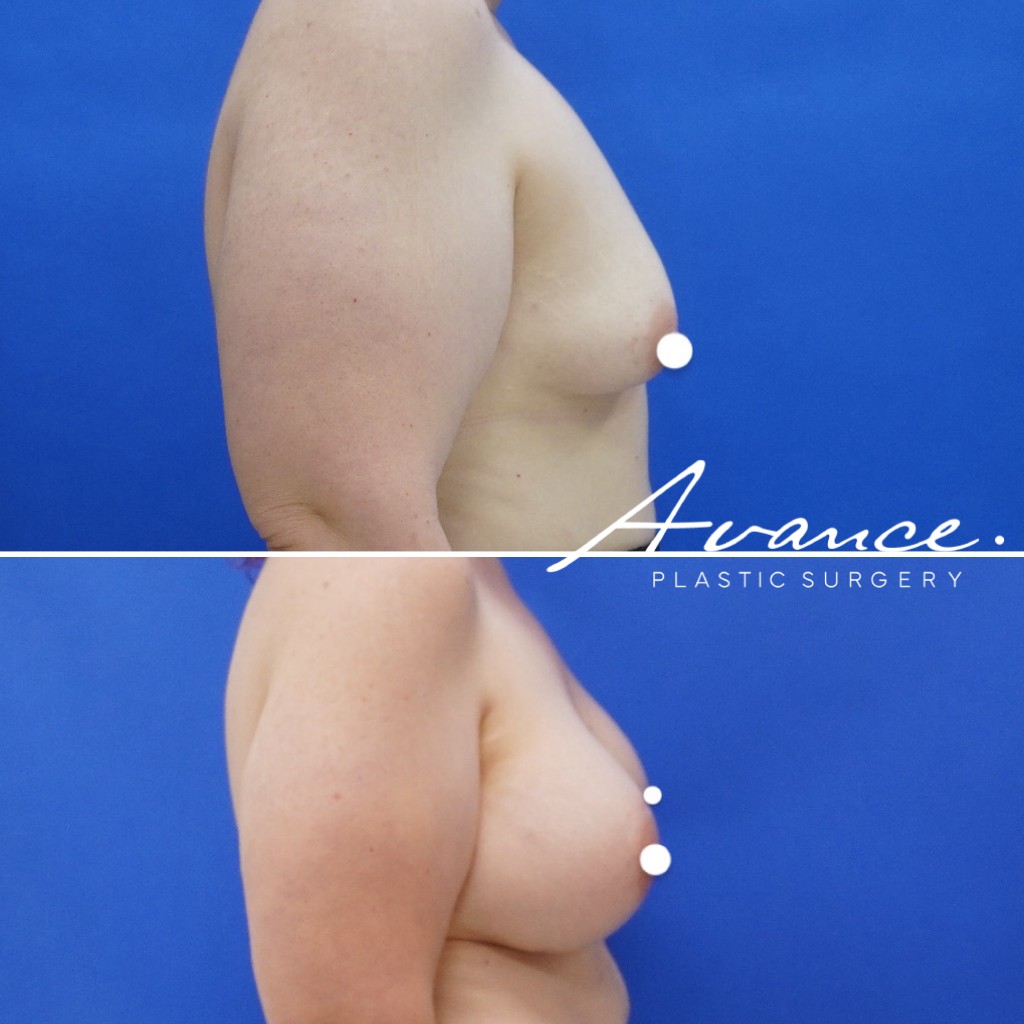 Before and After - Breast Augmentation