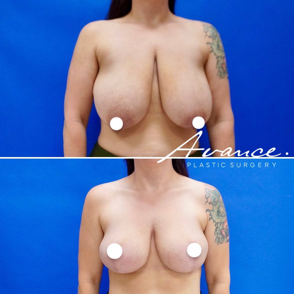 Before and After - Breast Reduction