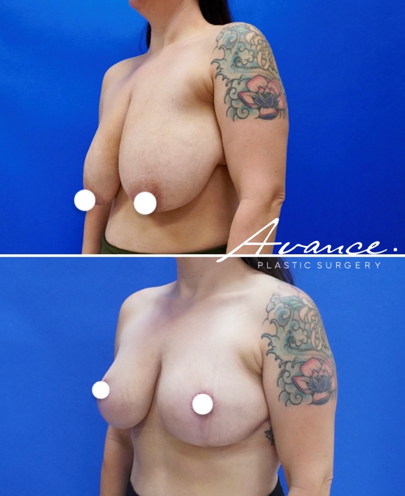Before and After - Breast Reduction