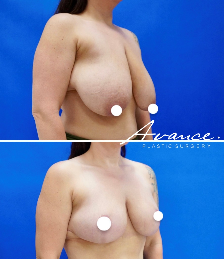 Before and After - Breast Reduction