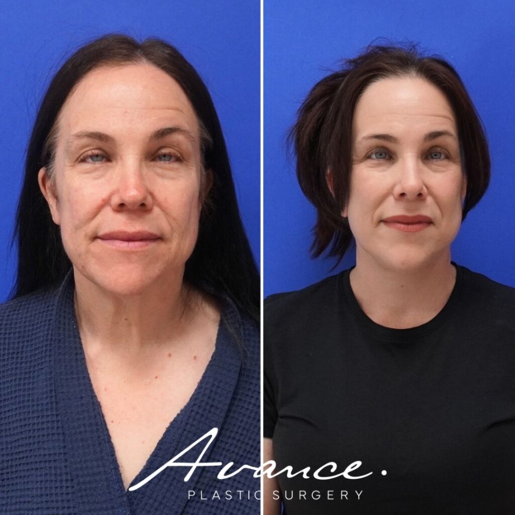 Before and After - Facelift/Necklift & Minifacelift/Necklift