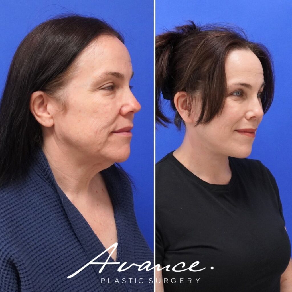 Before and After - Facelift/Necklift & Minifacelift/Necklift