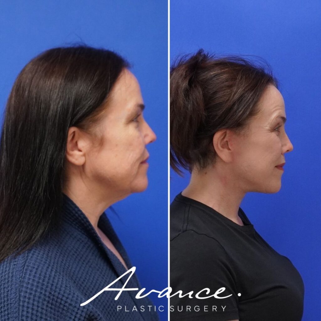 Before and After - Facelift/Necklift & Minifacelift/Necklift