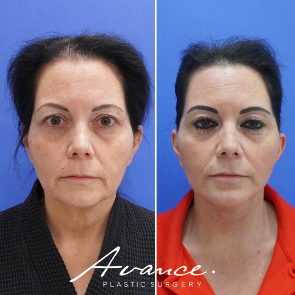 Before and After - Facelift/Necklift & Minifacelift/Necklift