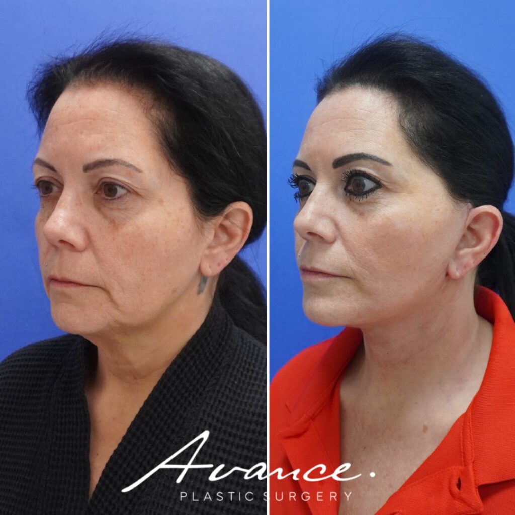 Before and After - Facelift/Necklift & Minifacelift/Necklift