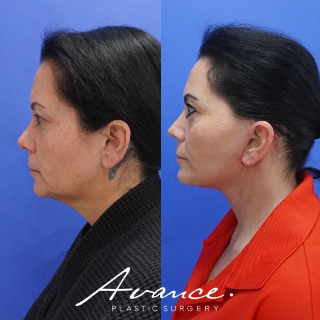 Before and After - Facelift/Necklift & Minifacelift/Necklift