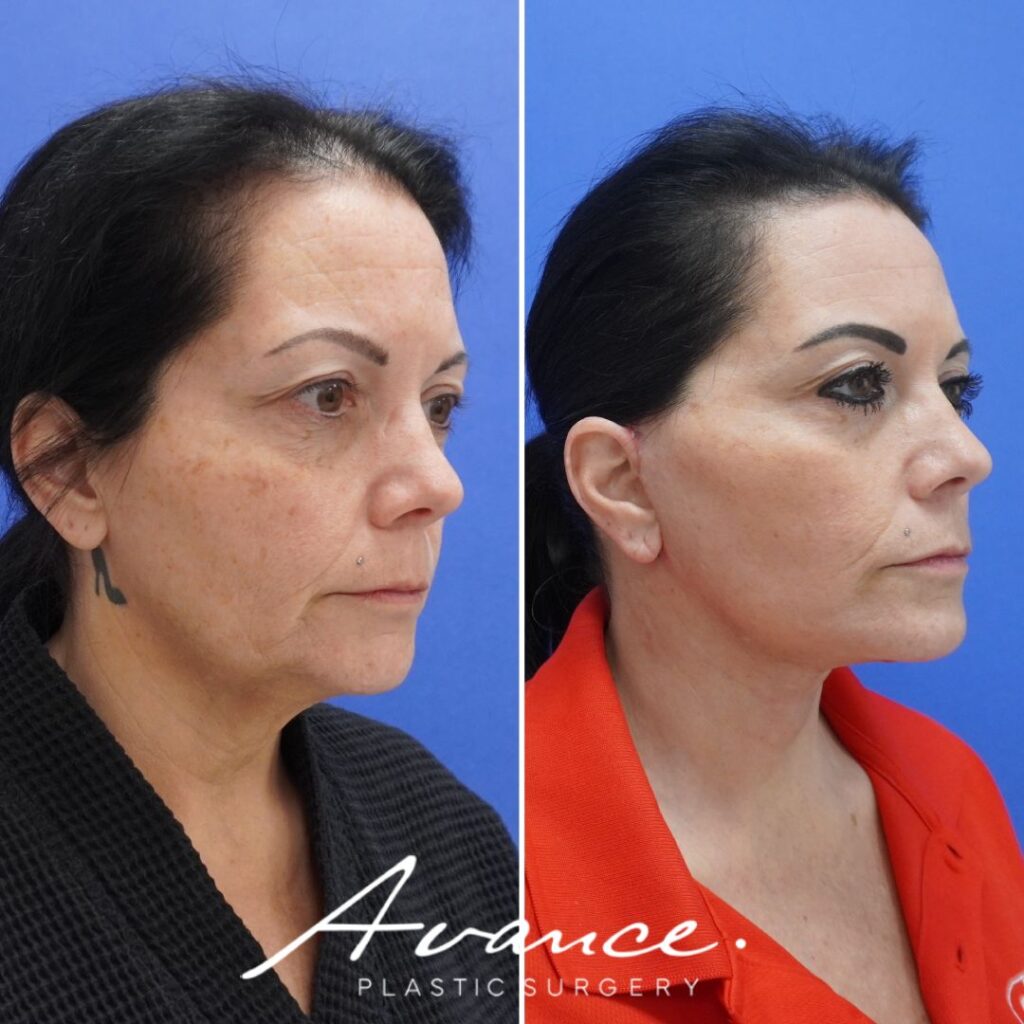 Before and After - Facelift/Necklift & Minifacelift/Necklift