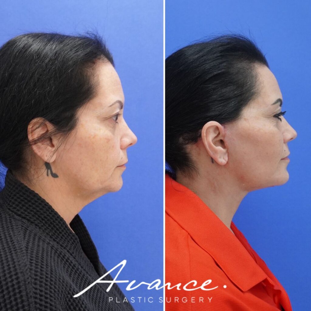Before and After - Facelift/Necklift & Minifacelift/Necklift