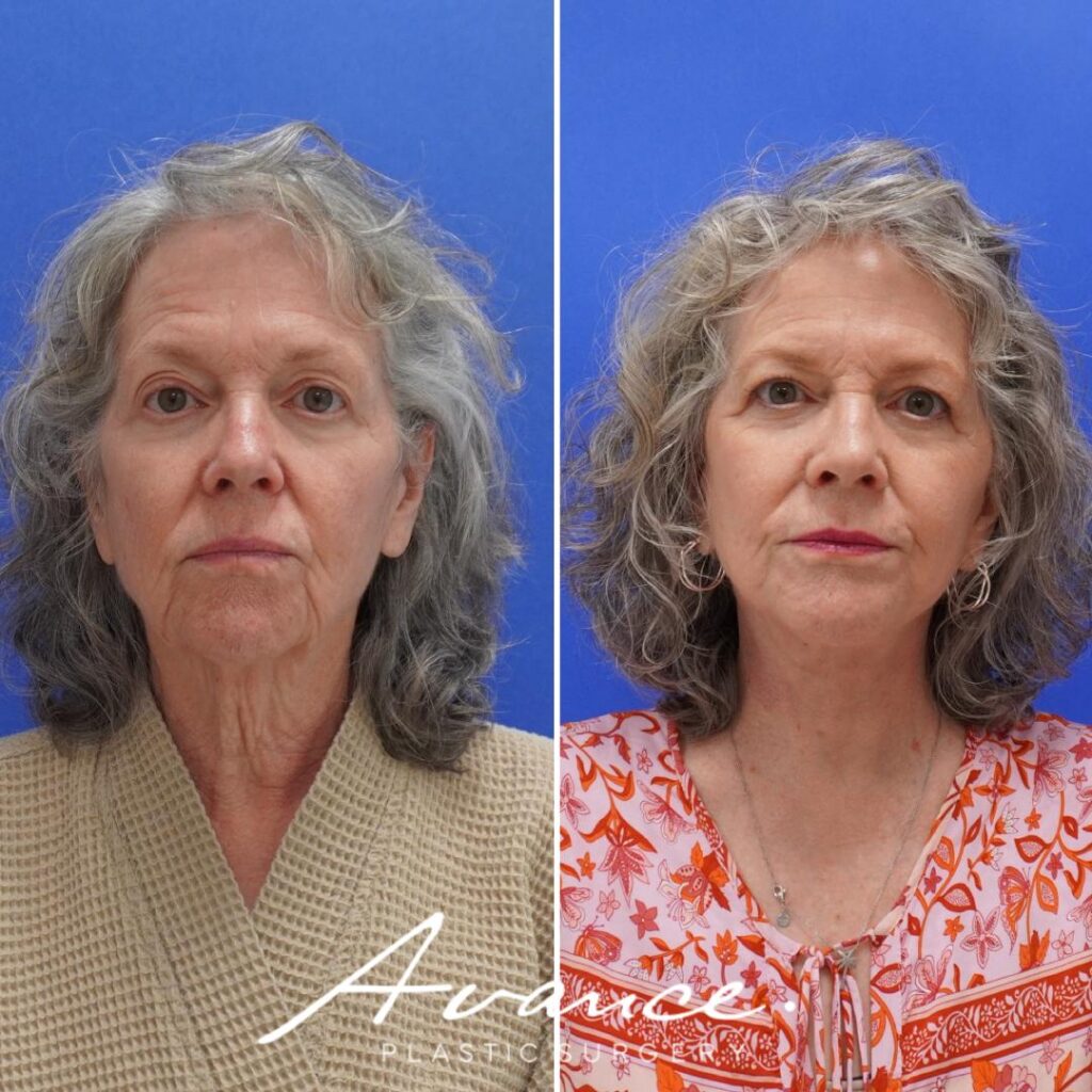 Before and After - Facelift/Necklift & Minifacelift/Necklift