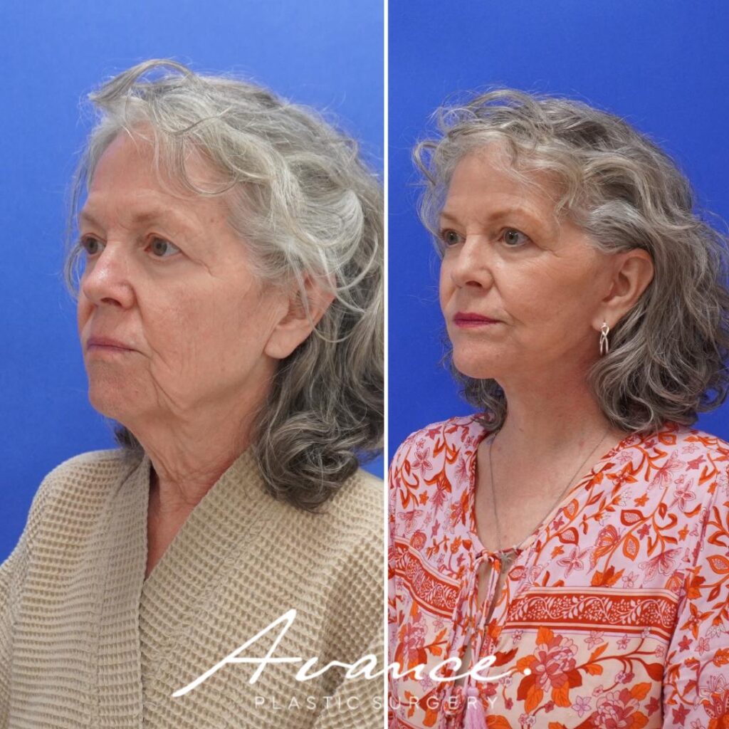 Before and After - Facelift/Necklift & Minifacelift/Necklift