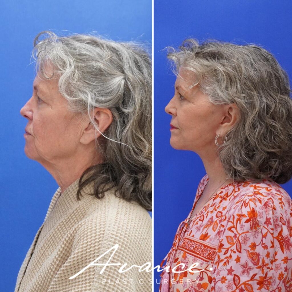 Before and After - Facelift/Necklift & Minifacelift/Necklift
