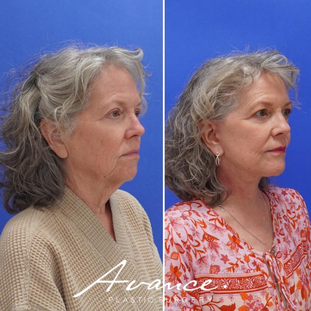 Before and After - Facelift/Necklift & Minifacelift/Necklift