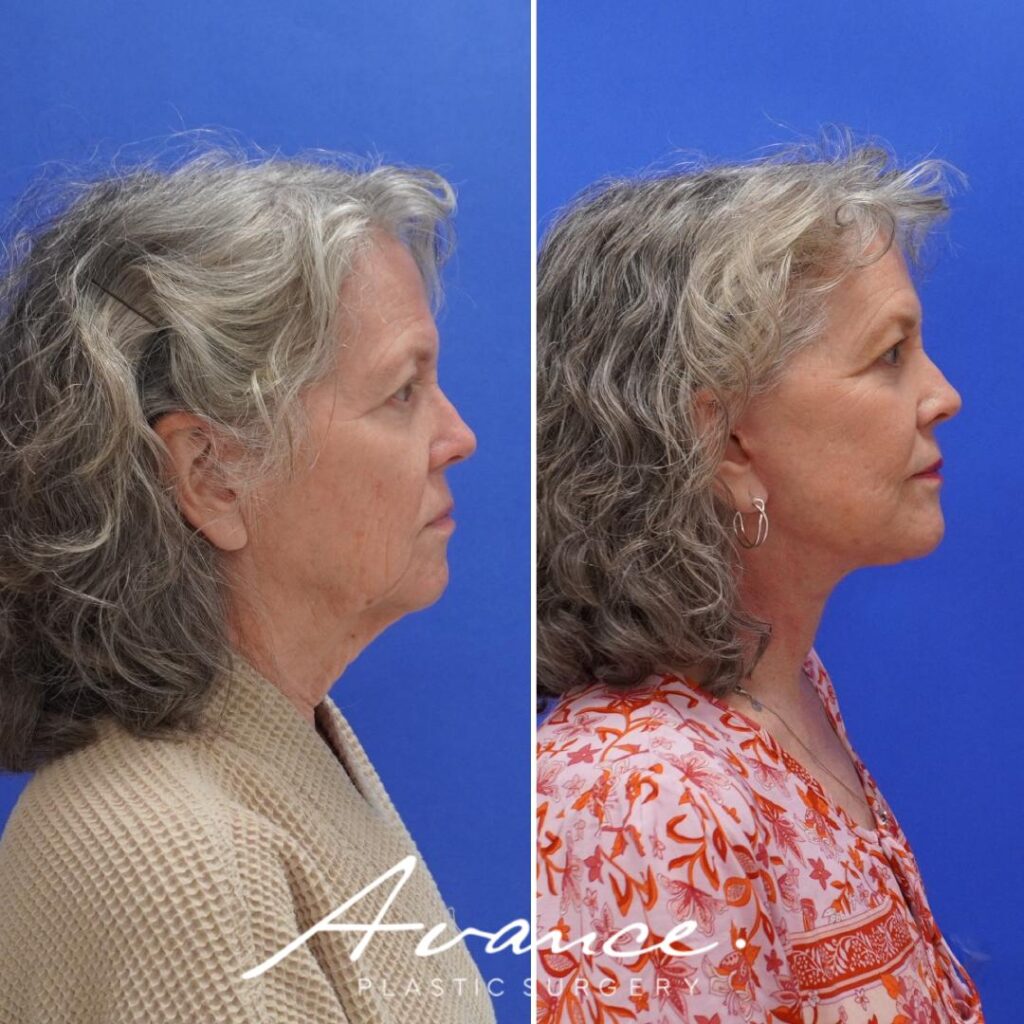 Before and After - Facelift/Necklift & Minifacelift/Necklift