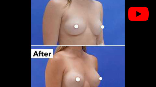 Before and After - Breast Augmentation