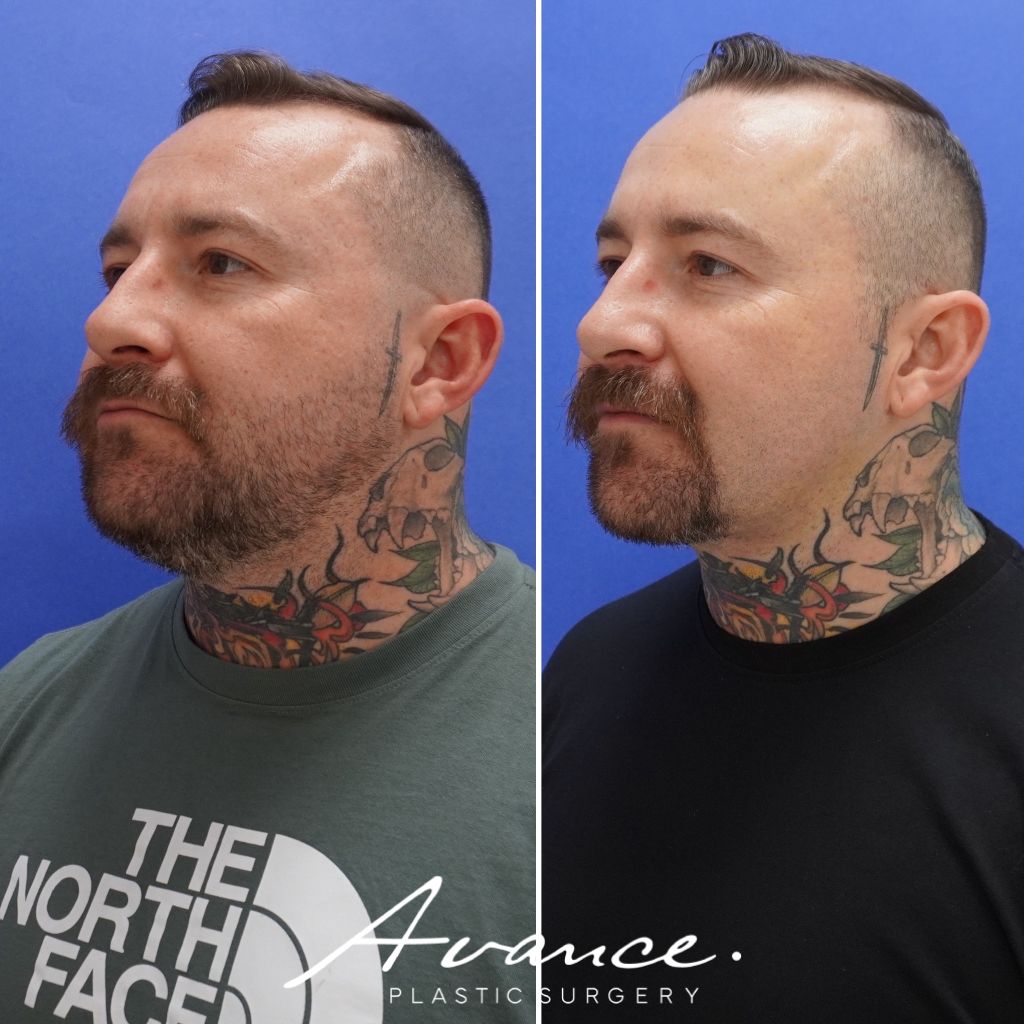 Before and After - Neck Liposuction