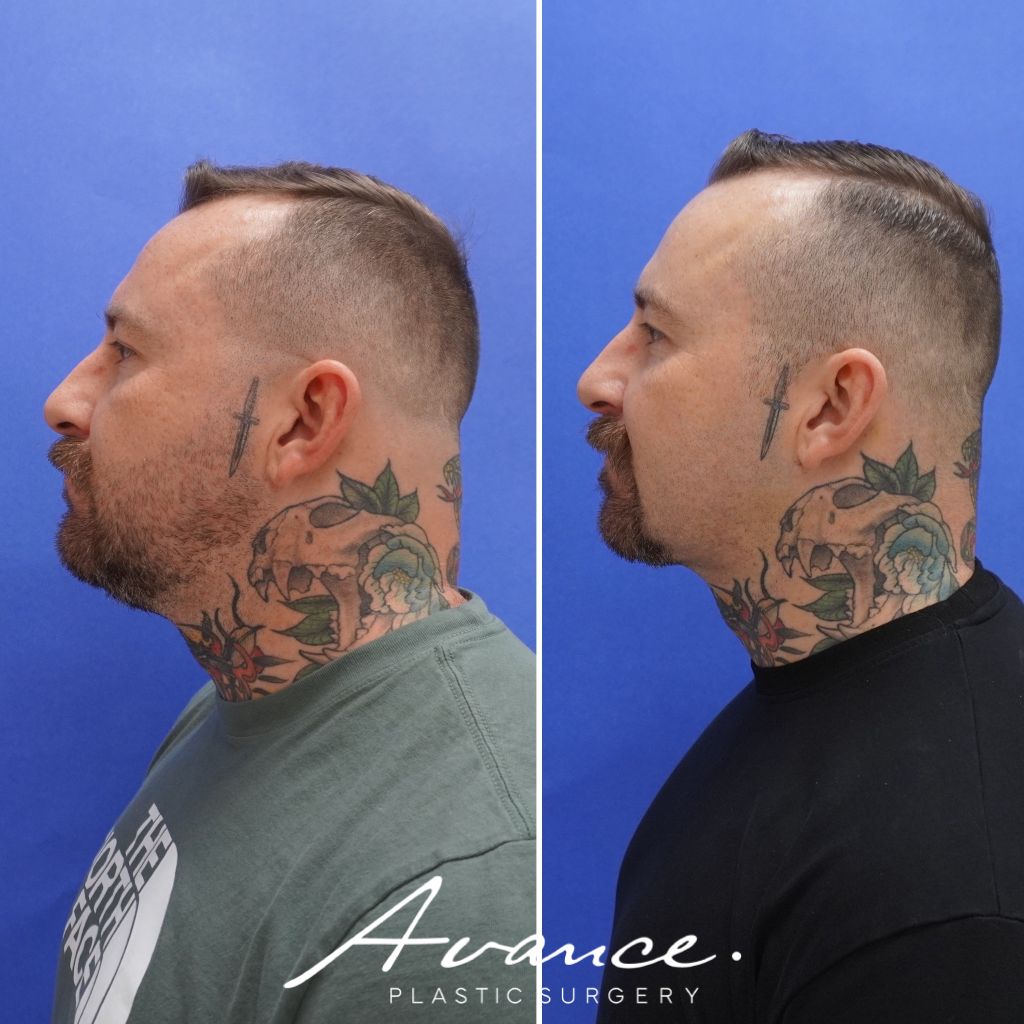 Before and After - Neck Liposuction