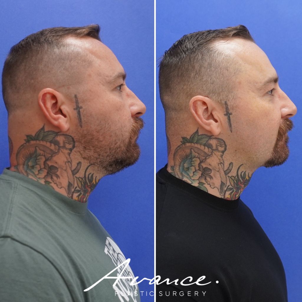 Before and After - Neck Liposuction