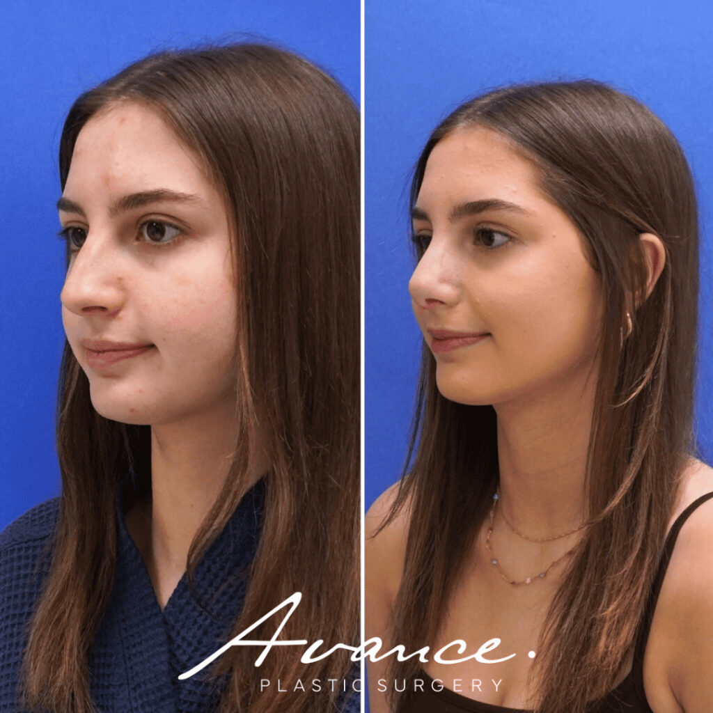 Before and After - Rhinoplasty