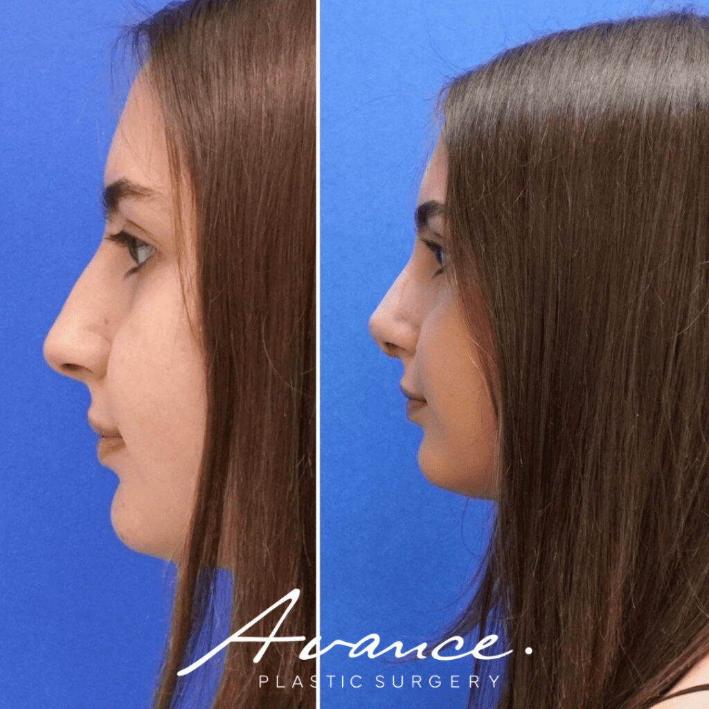 Before and After - Rhinoplasty