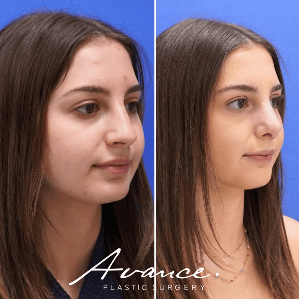 Before and After - Rhinoplasty