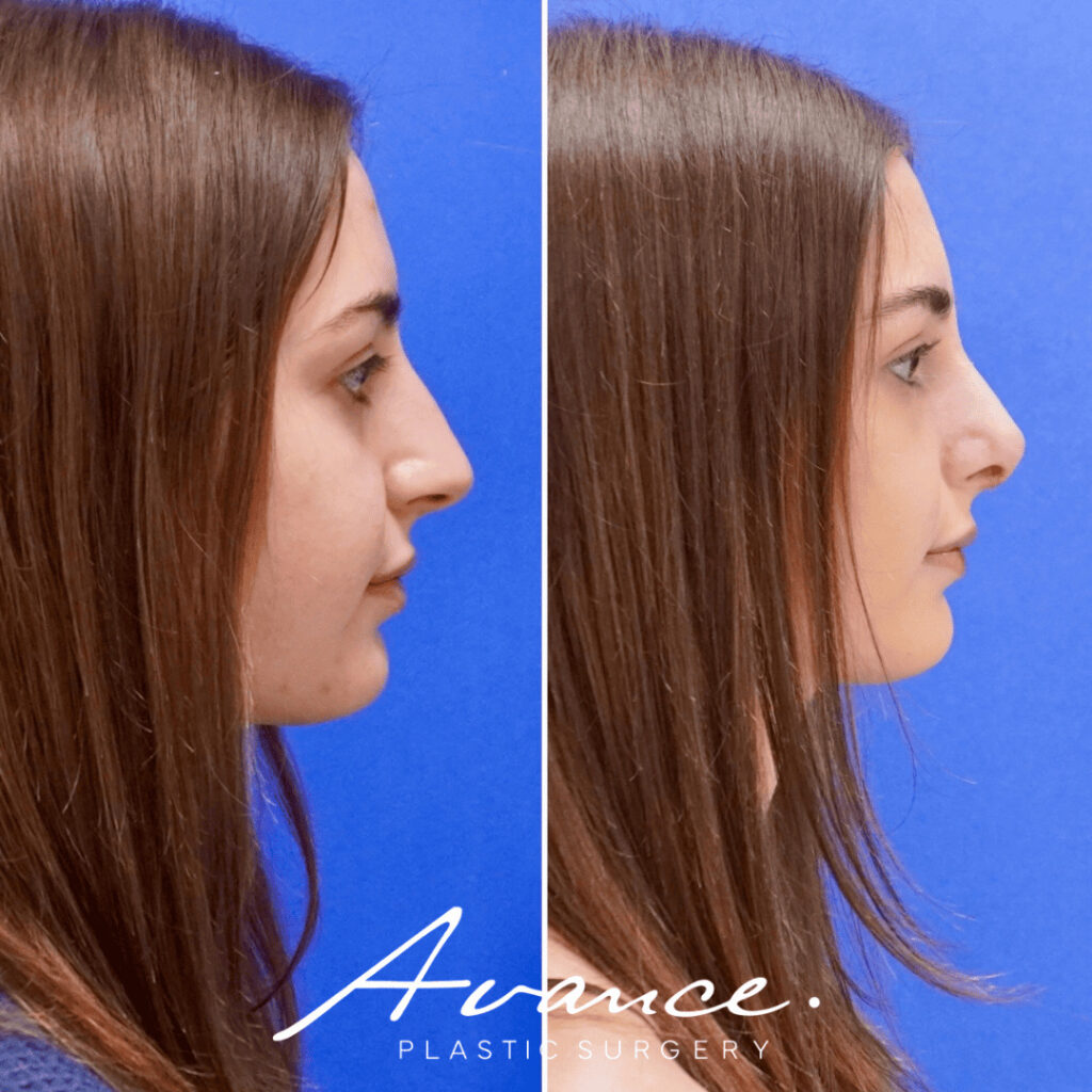 Before and After - Rhinoplasty