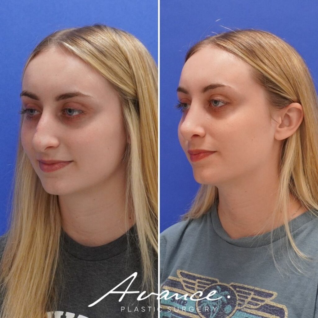 Before and After - Rhinoplasty