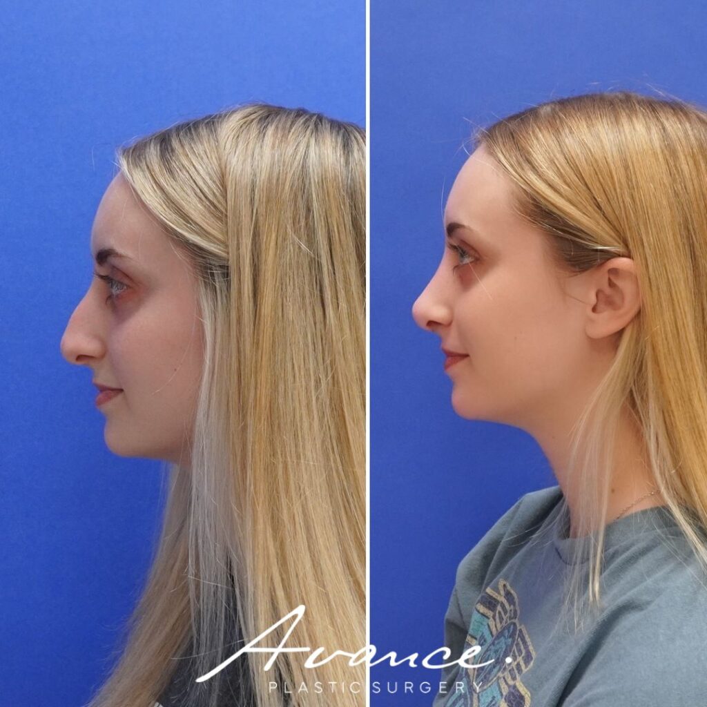 Before and After - Rhinoplasty