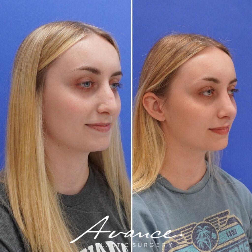 Before and After - Rhinoplasty