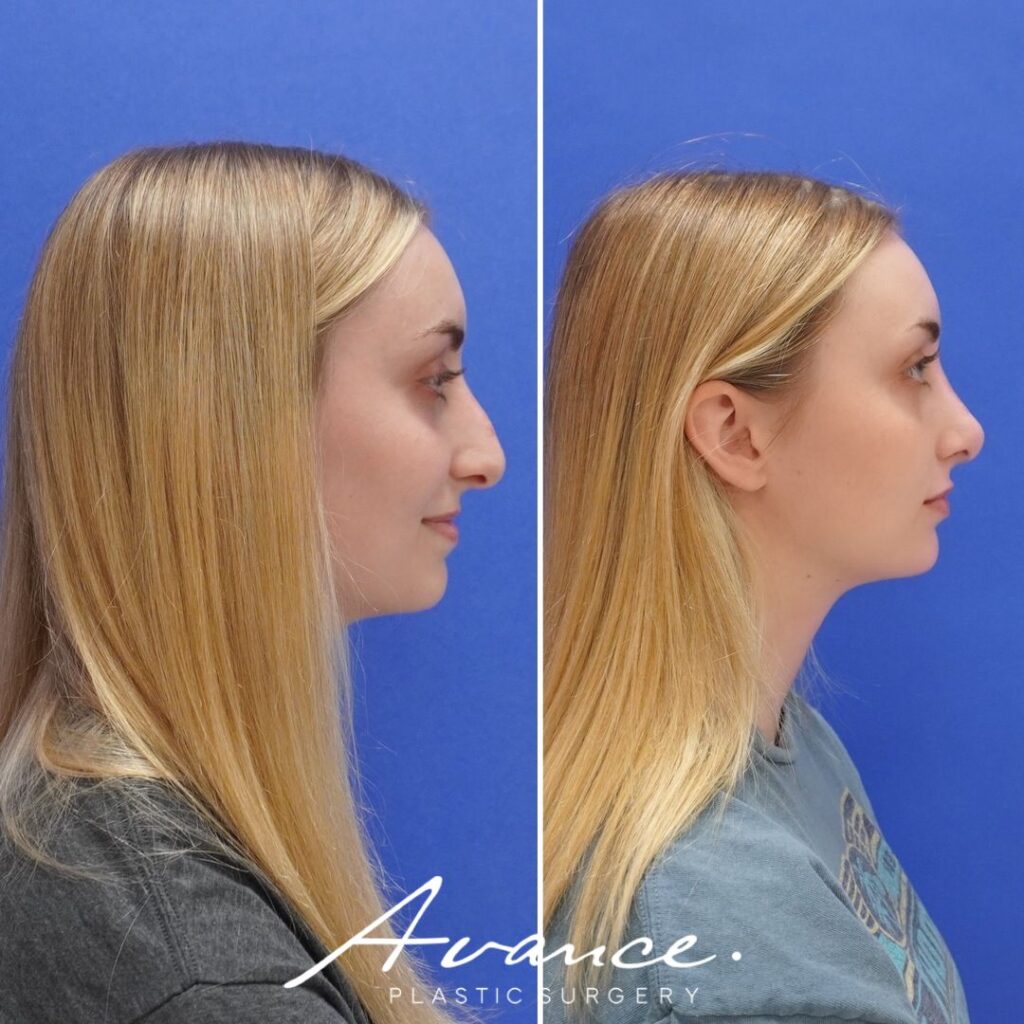 Before and After - Rhinoplasty
