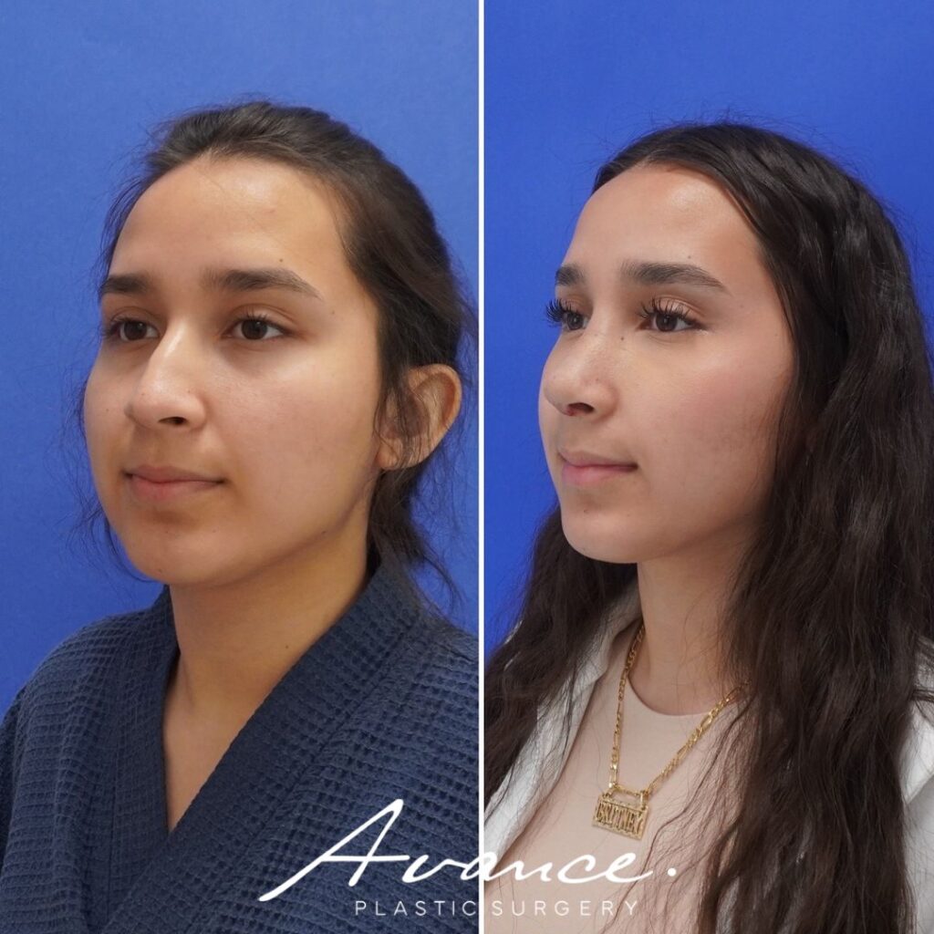 Before and After - Rhinoplasty