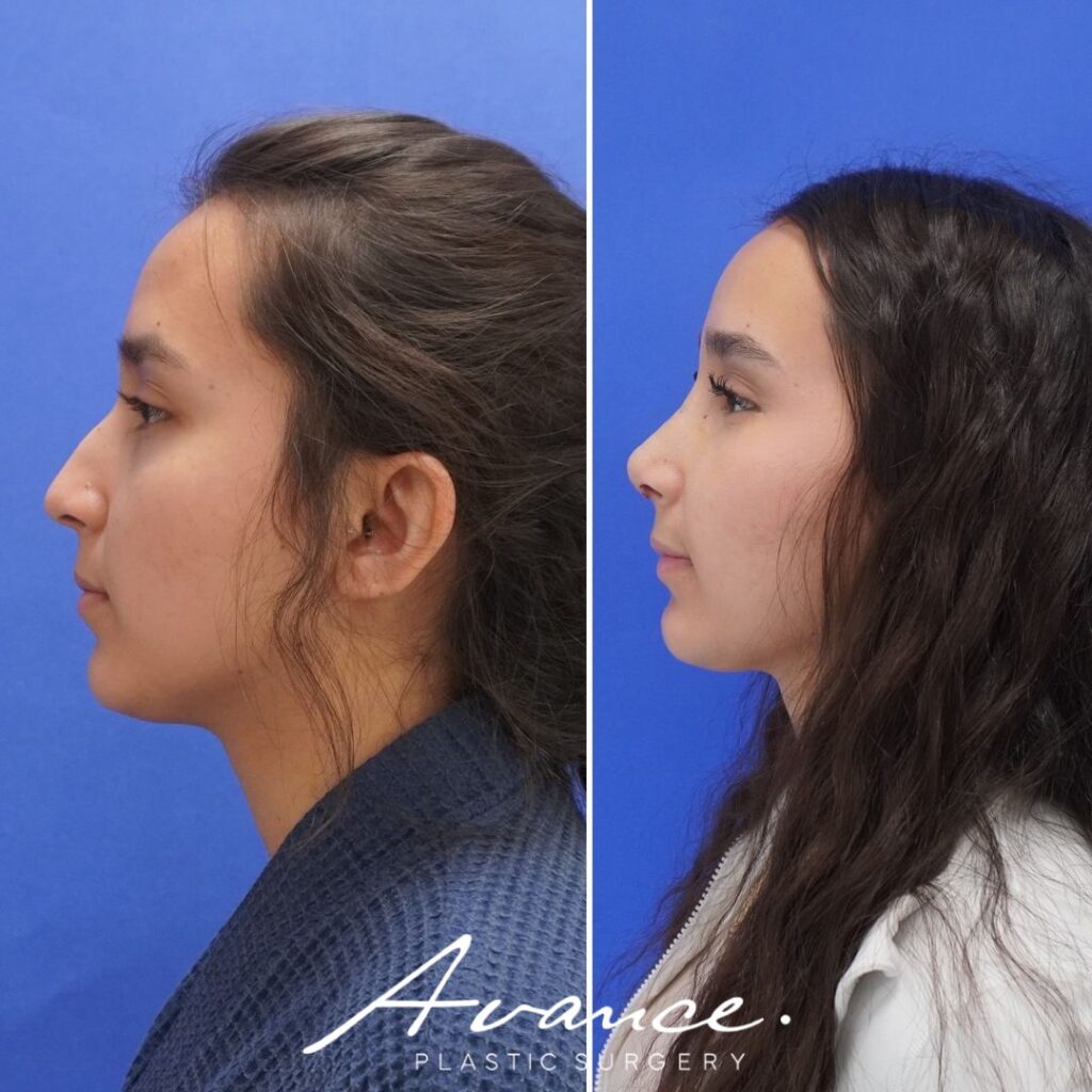 Before and After - Rhinoplasty