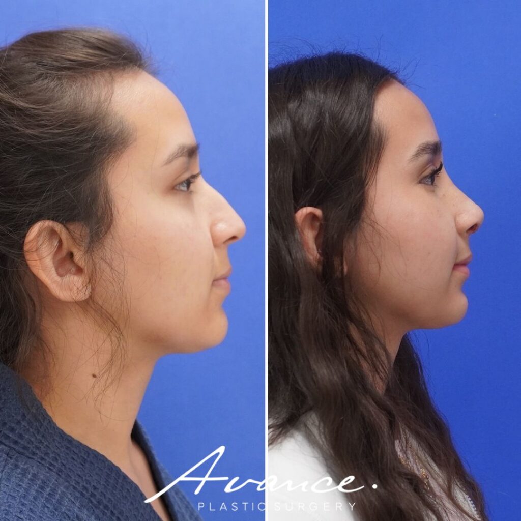 Before and After - Rhinoplasty